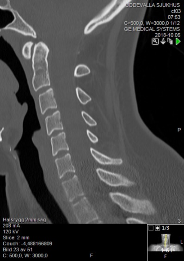 Ein Röntgenbild eines Mannes am Hals mit einem sichtbaren Bruch in der Mitte, das auf einem Computerbildschirm mit Text und Zahlen angezeigt wird.