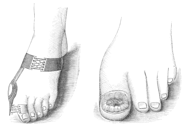 Schwarze und weiße Zeichnung von zwei Füßen, einer mit Verband und der andere mit Bruch, mit Text, der medizinische Behandlung angibt.