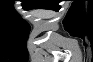 Schwarze und weiße MRI-Aufnahme eines Kniegelenks mit detaillierter Anatomie.